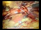 Necrosis pancre?tica infectada: necrosectom?a por laparoscopia
